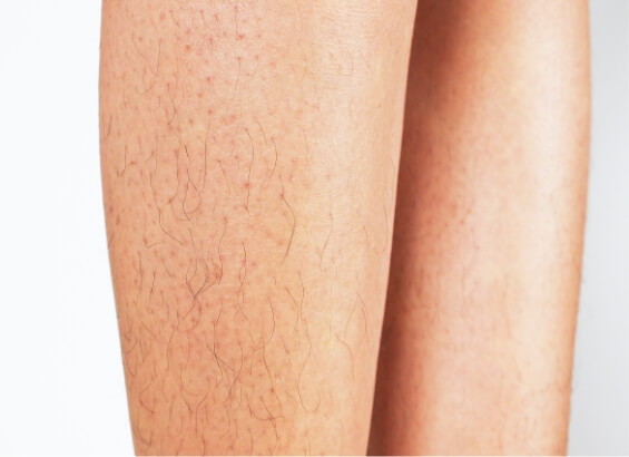 全身激光脫毛治療前的腿部特寫。