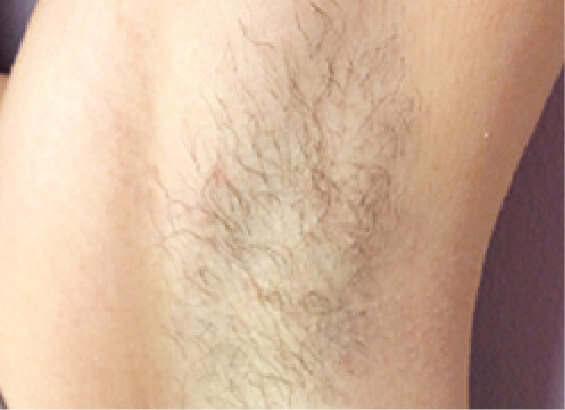 腋下激光脫毛治療前的腋下特寫。