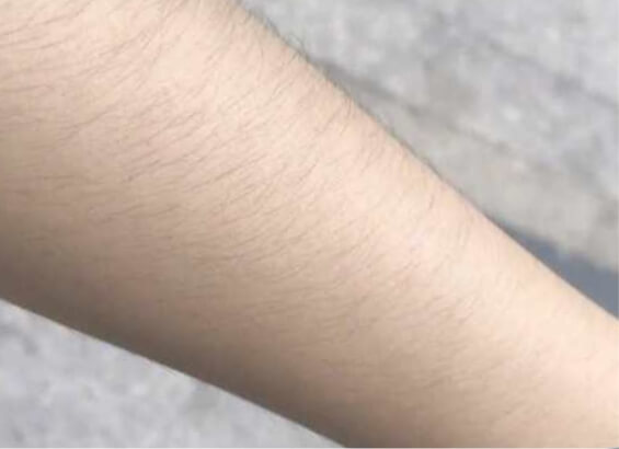 手部激光脫毛治療前的手部特寫。