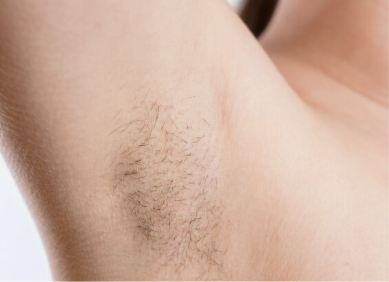 全身激光脫毛治療前的腋下特寫。